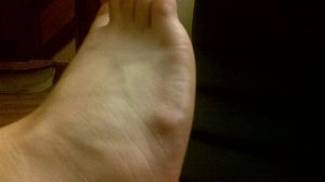 A ganglion cyst of the foot. (Ricethin / Wikimedia Commons)
