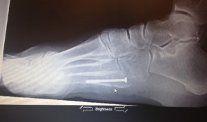 An X-Ray of a patient who has had a screw inserted into their foot. (Credit: Delray Beach Podiatry)