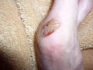 Painful Blisters (SusanLesch / Wikimedia Commons) 
