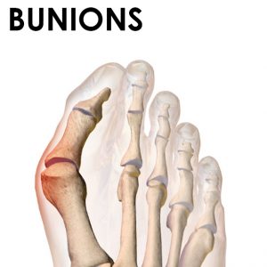 When should you see a podiatrist for your bunion pain? (Image: Wikimedia Commons)