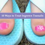 10 Ways to Treat Ingrown Toenails