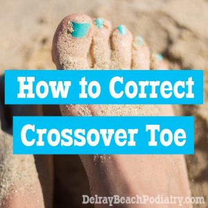 How do you correct crossover toe? Keep reading to find out!